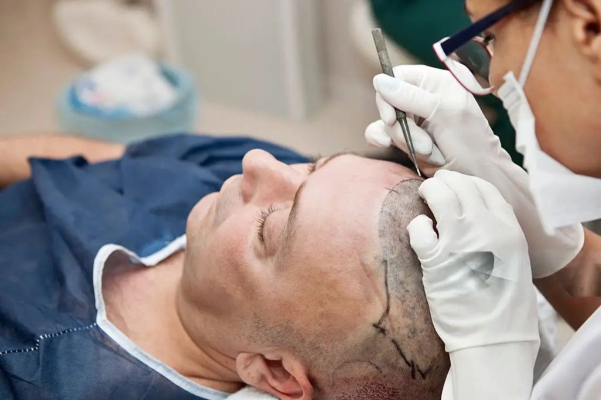 Hair Transplant