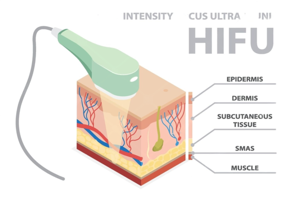 HIFU Treatment