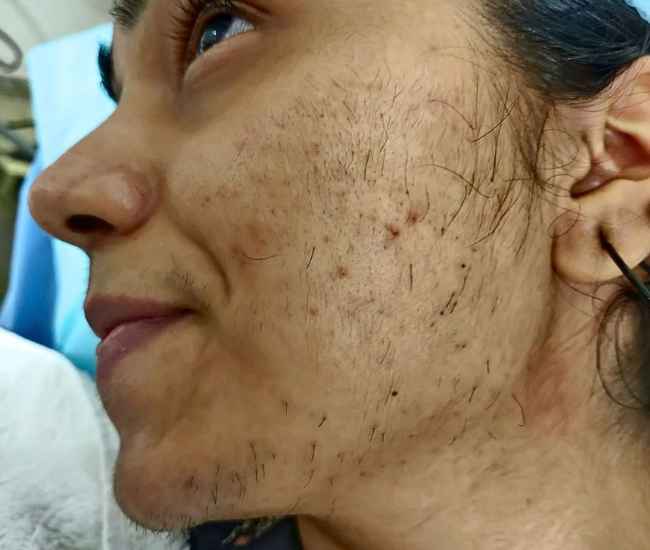 Laser Hair Removal Before