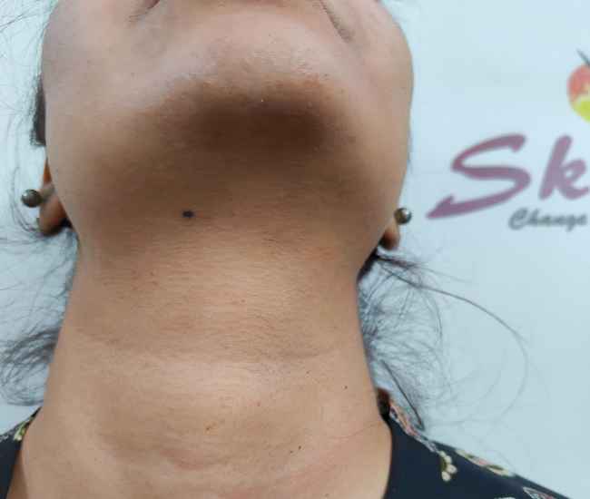 Laser Hair Removal Nack