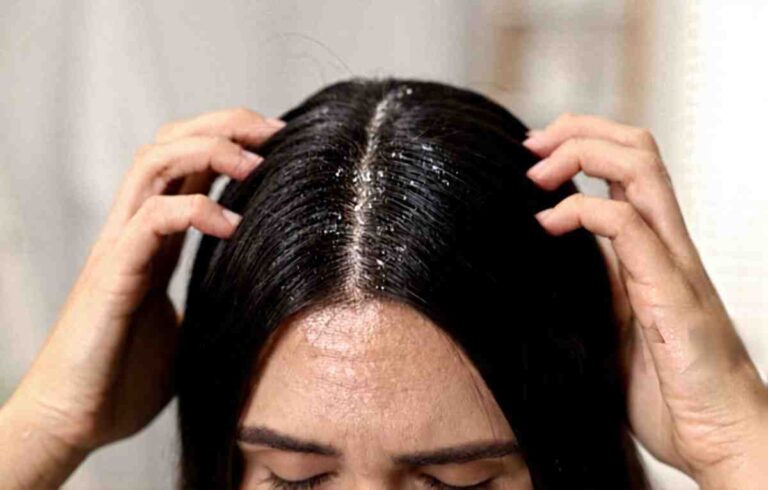 Dandruff Treatment
