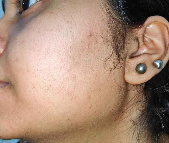 Laser Hair Removal After