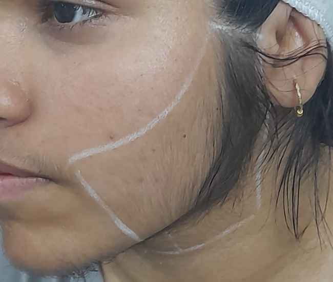 laser hair removal from cheeks