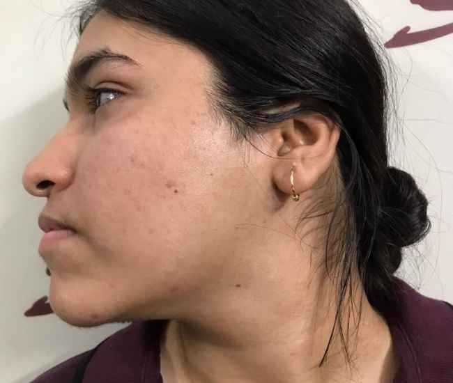 laser hair removal from cheeks