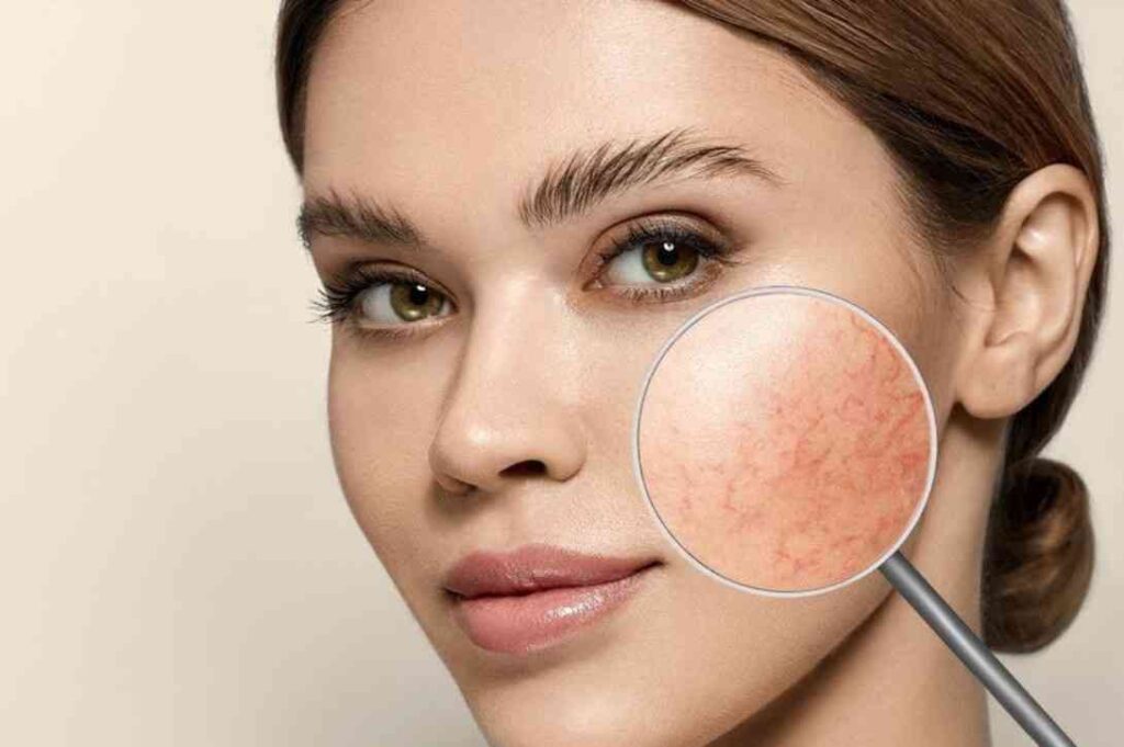 Sensitive skin & Rosacea