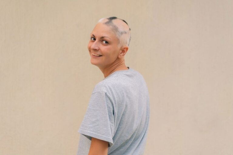 What is Alopecia Areata