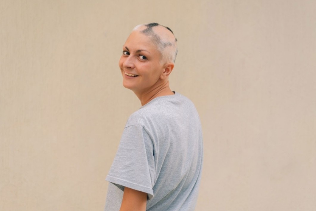 What is Alopecia Areata
