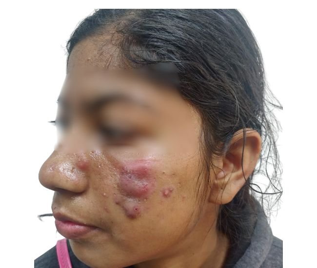 Pre bridal Acne treatment Result Pre bridal Acne treatment Result