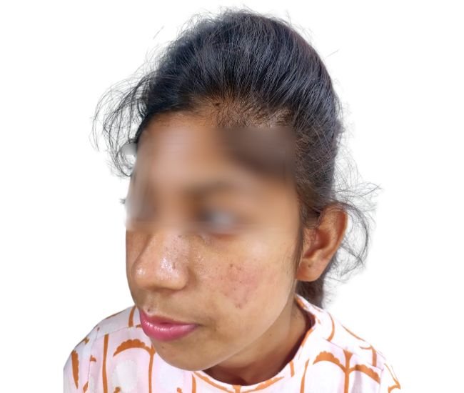 Pre bridal Acne treatment Result