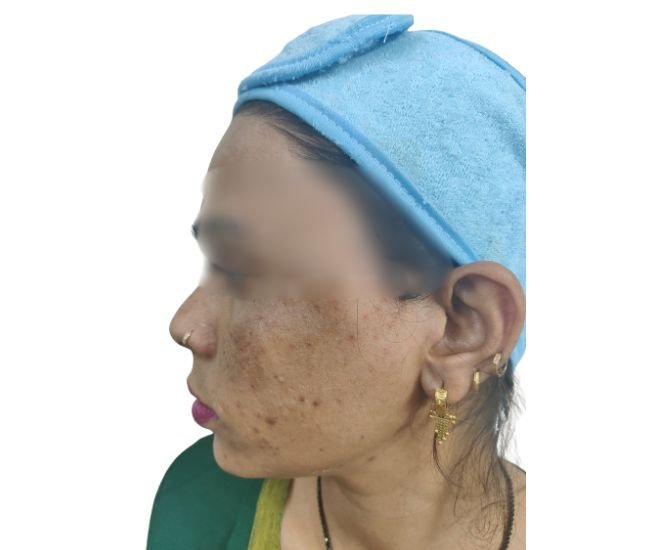 Pre bridal pigmentation treatment Pre bridal pigmentation treatment