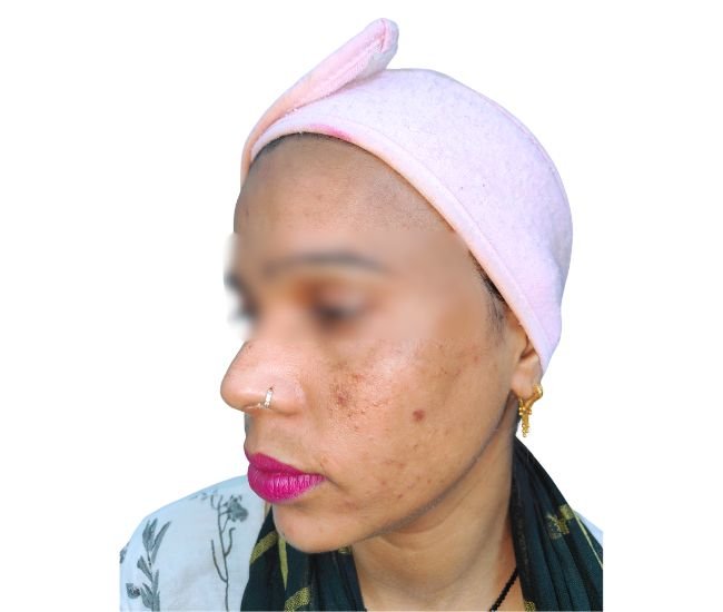 Pre bridal pigmentation treatment Result