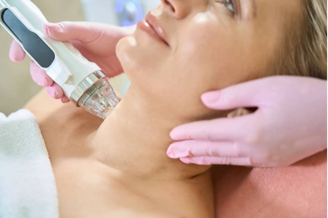 Microneedling